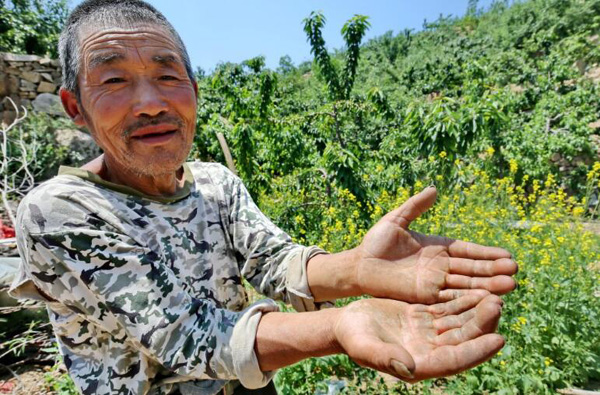 5月17日，赵景田老人在展示满是老茧的手。